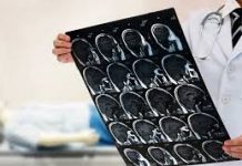 O şansă pentru bolnavii cu AVC