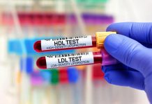 Afacerea ,,colesterolul“. Academicianul prof. dr. Ioan Bruckner: ,,Valoarea normală a colesterolului este 280 mg la 100 de ml de sânge“