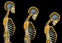 Boala „silenţioasă” care afectează milioane de români. Alimentația potrivită când suferim de osteoporoză