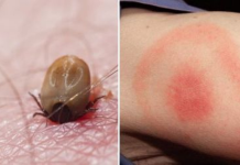 Tot mai mulți oameni ajung la spital mușcați de căpușe: Cum ne ferim și cum ne tratăm acasă