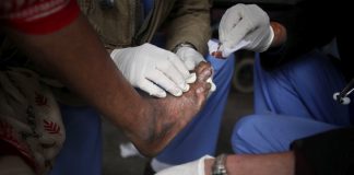 Asta mai lipsea. Două cazuri de lepră confirmate la Cluj. Pacientele sunt originare din Asia, imigranți, și lucrau la un salon SPA